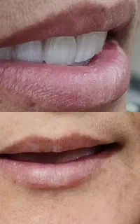 دندان مصنوعی پروتز متحرک