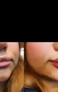 پاک کردن خالکوبی و تتو صورت وبدن با لیزر کیوسوئیچ