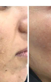 رفع جای جوش،جای بخیه با لیزر