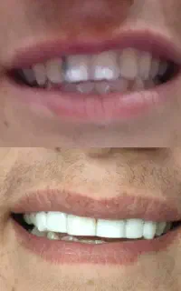 کامپوزیت۷۵۰هزارتومن تخفیفی /دندان مصنوعی