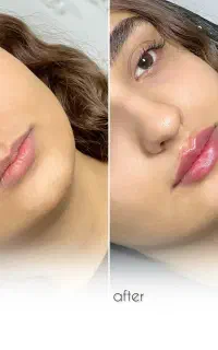 لیزر پی ار پی ژل لب بوتاکس لیفت نخ فیلر باسن