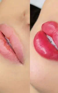 تزریق ژل و بوتاکس و آموزش
