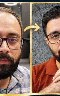 کاشت مو و ابرو در کلینیک تخصصی اقساطی