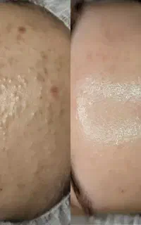 تخفیفات لیزر و فیشال
