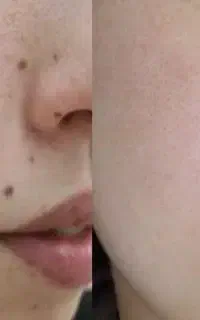 همکاری با کلینیک برای خال برداری و پلاسما(کارجو)