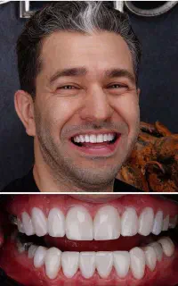 جشنواره ونیر کامپوزیت لمینیت روکش دندان عصب IPS