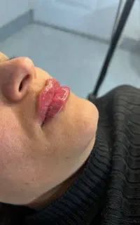 آموزش ژل و بوتاکس