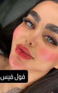 ژل‌لب‌سیب‌گونه‌‌کات‌گونه‌قوزبینی‌لیفت‌بینی