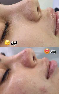 فیشیال و پاکسازی تخصصی پوست در لنگرود و لاهیجان