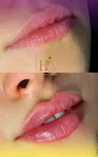 فیلر ، بوتاکس ، پی آر پی ، مزو