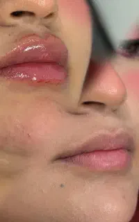تزریق فول فیس ۶۸۰۰ با بوتاکس رایگان تا آخر ماه