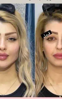 تخفیف ویژه۳روزه ژل فیلر بوتاکس مادلینگ پی آرپی مزو