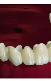 ساخت انواع روکش دندان ثابت تمام سرامیک
