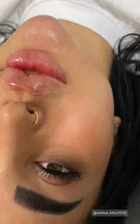 اموزش تزریق فیلر و بوتاکس