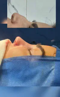 جراحی بینی در تبریز شرایط قسطی