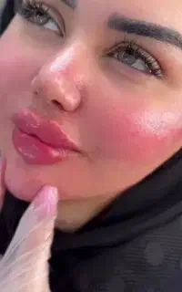 ژل و بوتاکس مزو مو تخصصی آقایان و خانم ها در الهیه