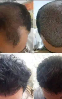 کاشت مو و ابرو با کم ترین قیمت اقساطی