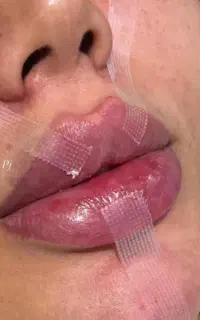 جشنواره عیدانه ژل فیلر بوتاکس