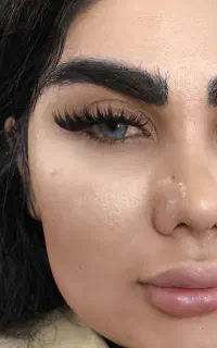 کاشت مژه کایلی