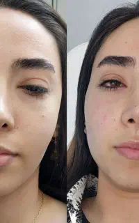آموزش پیشرفته ژل وبوتاکس پی آرپی وبایوفیلر