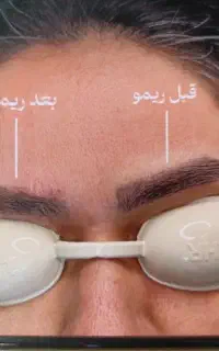 پاک کردن و ریموو انواع تتو وجوانسازی