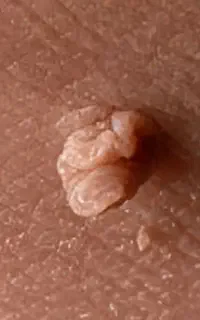 از بین بردن تضمینی زائده