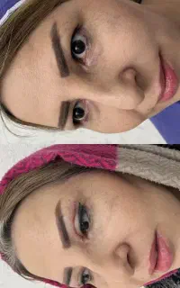 بلفاروپلاستی توسط دکتر نوتاش (تبریز)