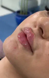 جشنواره ژل فیلر بوتاکس مزوتراپی prpتخصصی توسط پزشک