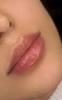 تخفیف ویژه ژل و بوتاکس