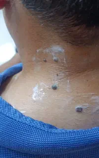 خال ولک وجوش زیر پوستی بدون درد