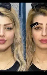 برداشتن خال۲۰ت،بوتاکس،ختنه.بادی شقیقه.ژل۳۹۰فول فیس