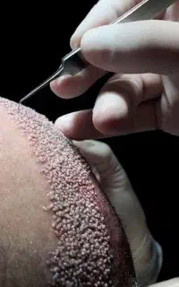 استخدام در لاین کاشت مو و ابرو در کلینیک زیبایی
