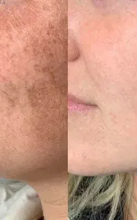 فیشال و پاکسازی پلاژن اسید درمان جوش،لک،منافذ