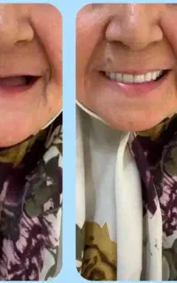 دندانسازی ساخت دندان متحرک (اوردنچر)در یزد