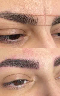 پذیرش محدود فیبروز‌ ابرو
