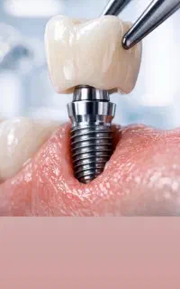 ایمپلنت دیجیتال ، متخصص اطفال ،ارتودنسی،
