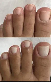 پدیکور درمانی رفع کامل ترک پا برای خانم ها