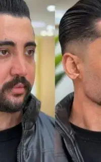 بوتاکس لیفت صورت فیلرزاویه لب پی آر پی مزوتراپی