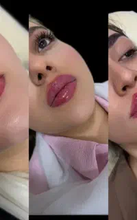 تزریق ژل، بوتاکس و مزوژل prp بایوفیلر