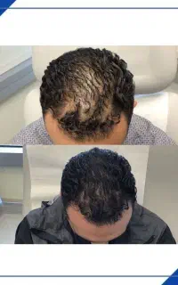 چرا کاشت مو حالا ممنوع شد