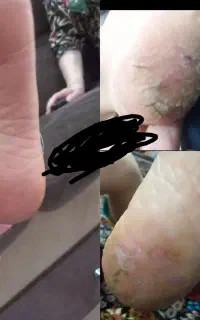 پک بهداشتی و درمانی ترک پا