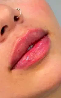 تزریق فیلر لب توسط پزشک با دریافت فقط هزینه مواد