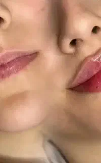 تخفیف ویژه تزریق ژل و بوتاکس ۱۲۰۰