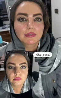 تزریق پک ده سی سی اودری6500