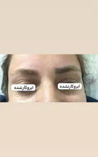 لیزر پاک کردن تاتو کیوسوییچ هایفوفرکشنالco2