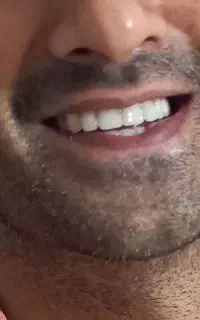 ساخت دندان مصنوعی بالاترین کیفیت