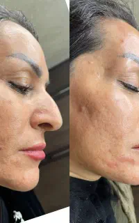 قبل و بعدهای شگفت انگیزژل،فیلربوتاکس صورت. زیر بغل