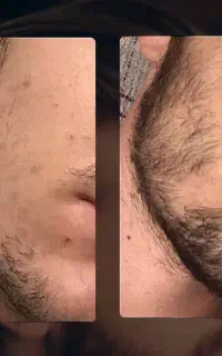 فولیکول‌هاتو از گرسنگی نجات بده