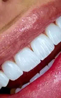 کامپوزیت دندان/ترمیم شکستگی/کاشت/رفع پوسیدگی/