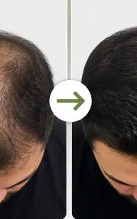 با کچل شدن خدافظی کن